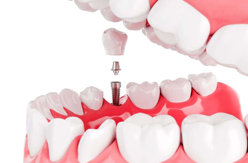 Implantology and Restoration